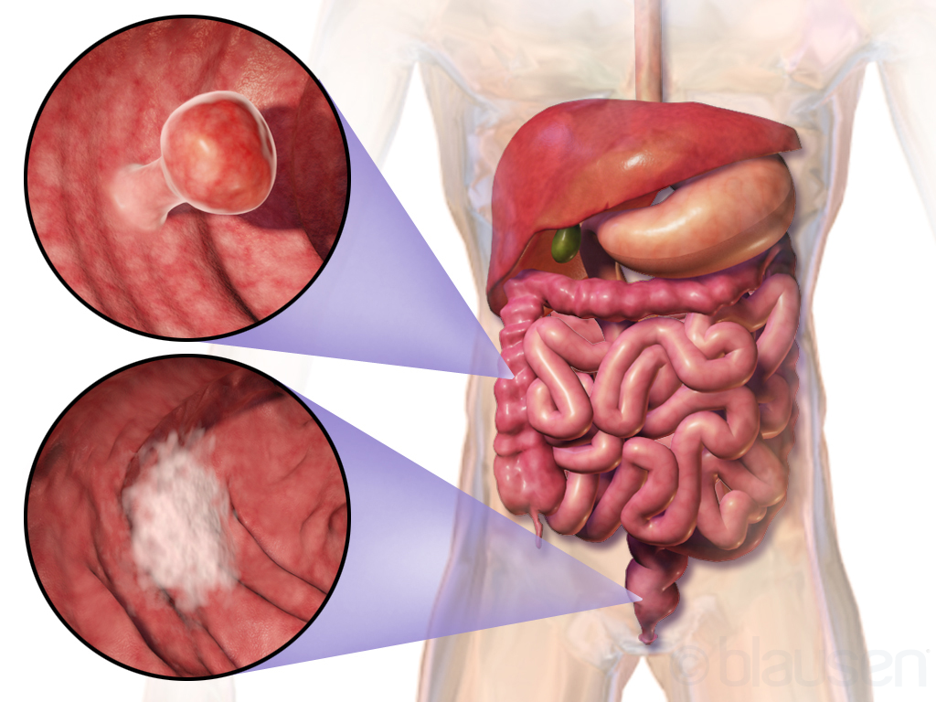 cancerblogimage1